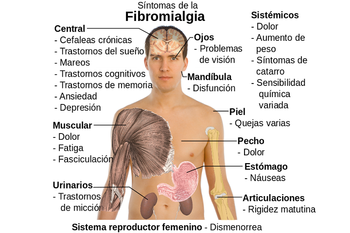 Hablemos De Fibromialgia Hoja Del Lunes